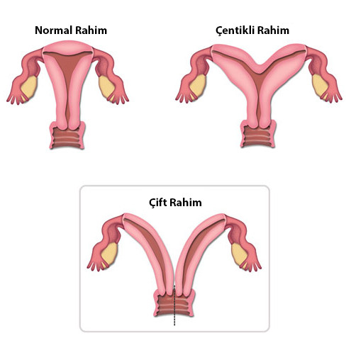 çift rahim nedir