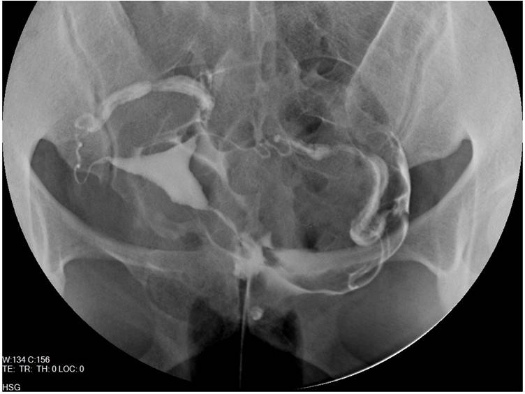 Histerosalpingografi (HSG) nedir